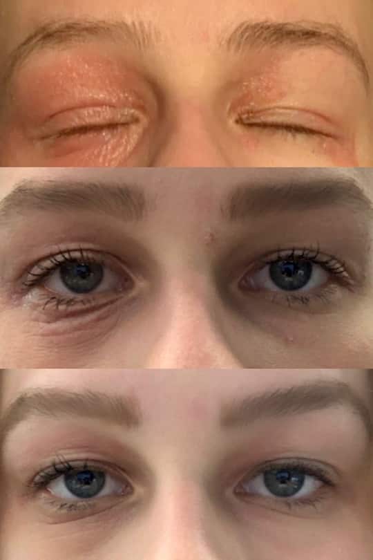 Neurodermitis Entwicklung Lara