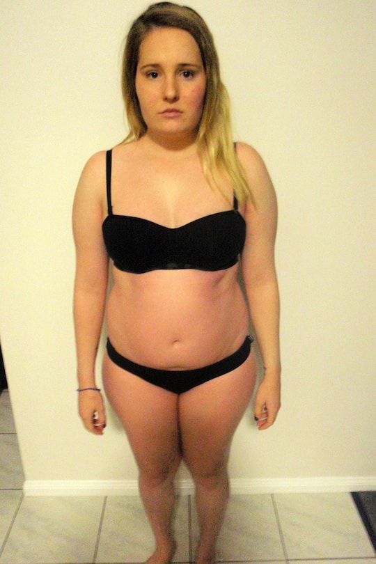 Gemma Walker Anorexie Magersucht Bulimie vorher nachher fast tot